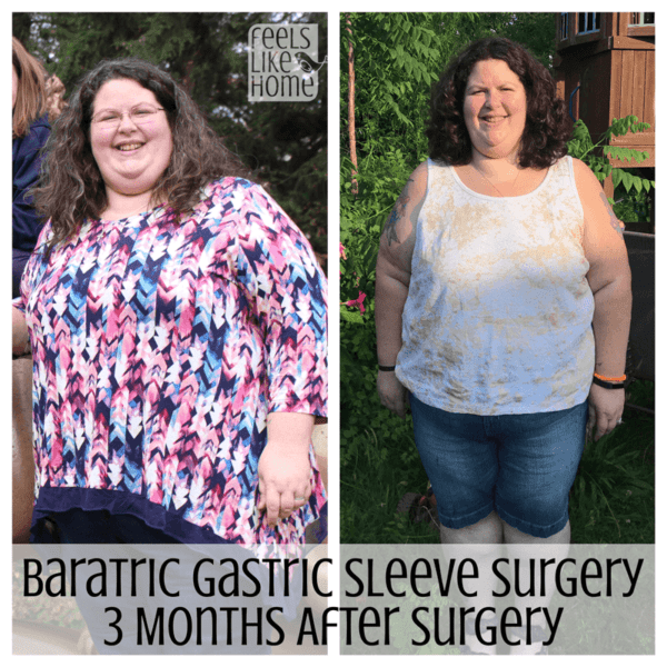 Tara Ziegmont posing for a photo before and after bariatric surgery