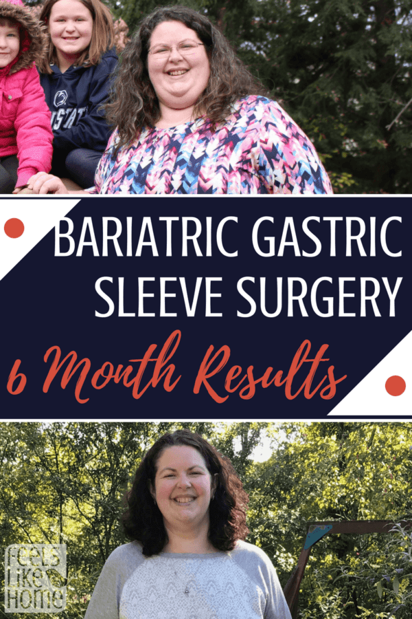 Bariatric Gastric Sleeve Surgery Results - 6 Months Post-Op - Feels Like  Home™