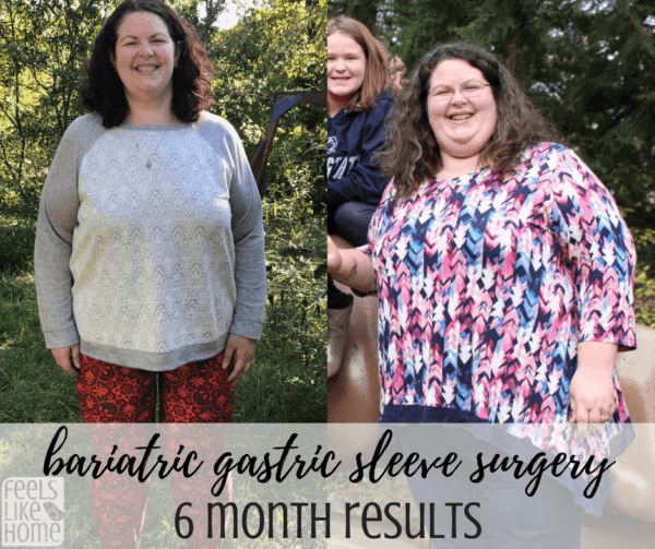 Bariatric Gastric Sleeve Surgery Results 6 Months Post Op Feels Like Home™ 0804