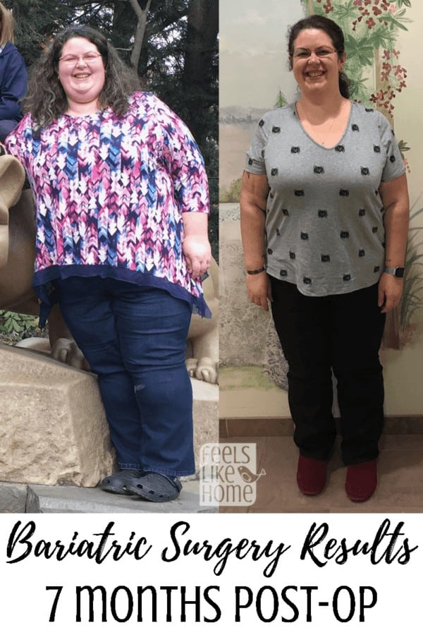 WEIGHT LOSS SURGERY UPDATE (Gastric Sleeve 12 months post op) 