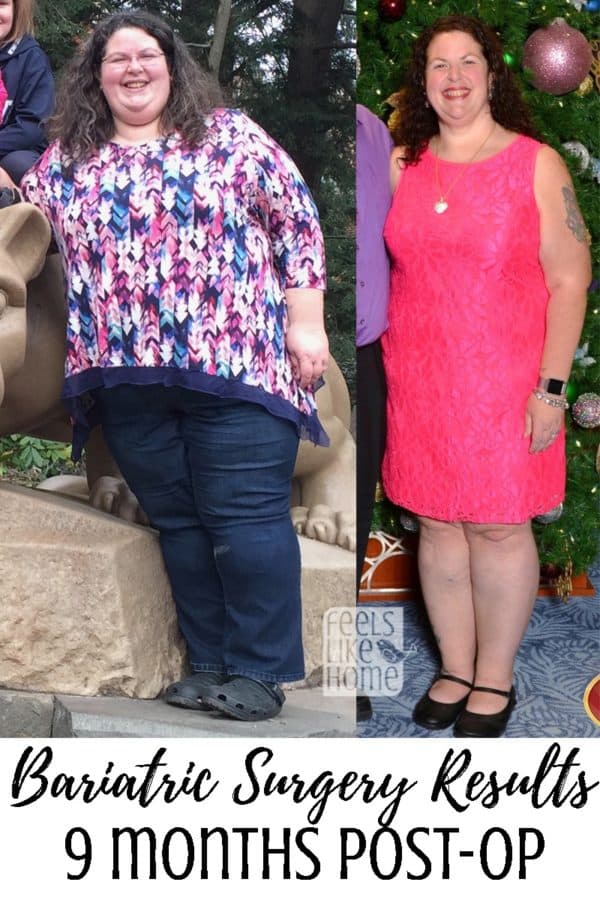 Tara Ziegmont posing for the camera before and after bariatric surgery