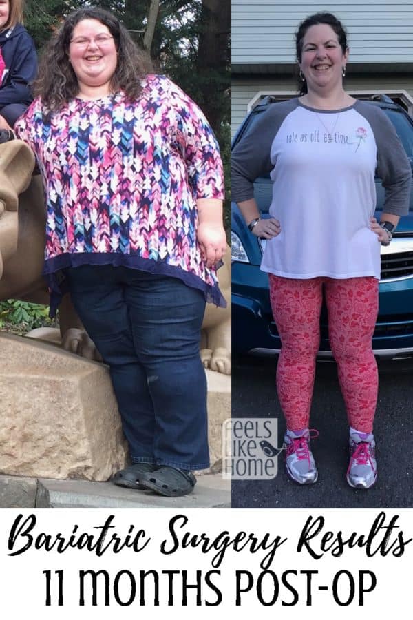 Tara Ziegmont posing for the camera before and after bariatric gastric sleeve surgery