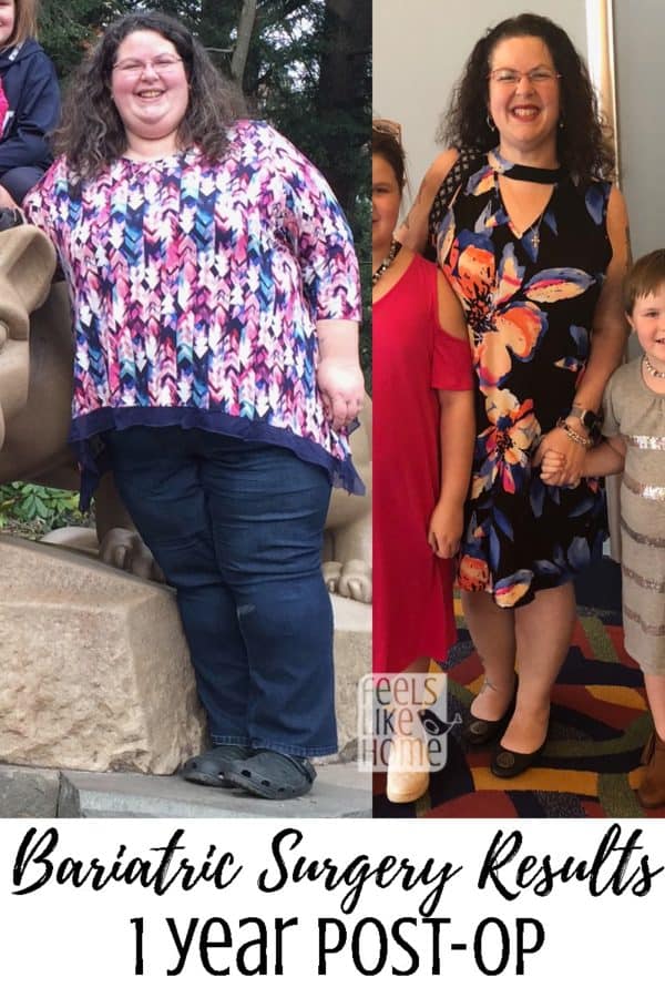 Tara Ziegmont posing for the camera before and after bariatric surgery