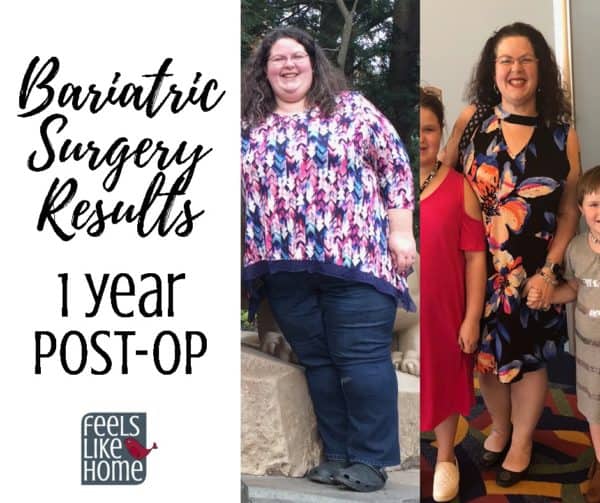 Bariatric Gastric Sleeve Surgery Update And Results 1 Year Post Op Feels Like Home™ 